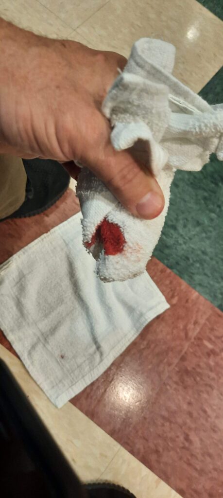 Cut finger from rotary cutter