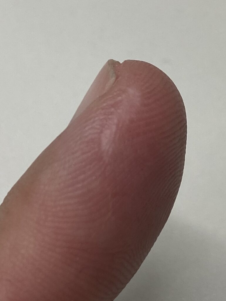Scar on finger 4 months after rotary cutter cut my finger 